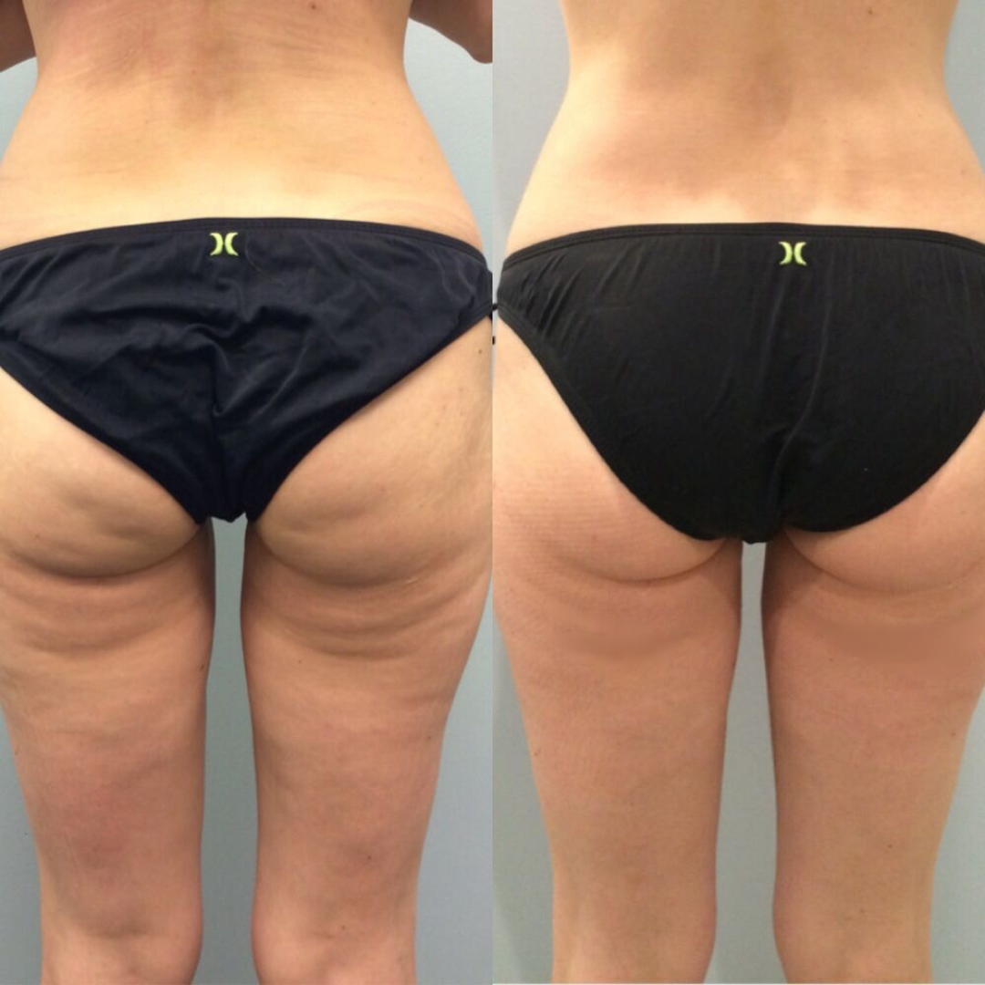 ZENOVA® Pressothérapie - Pack ESSENTIEL