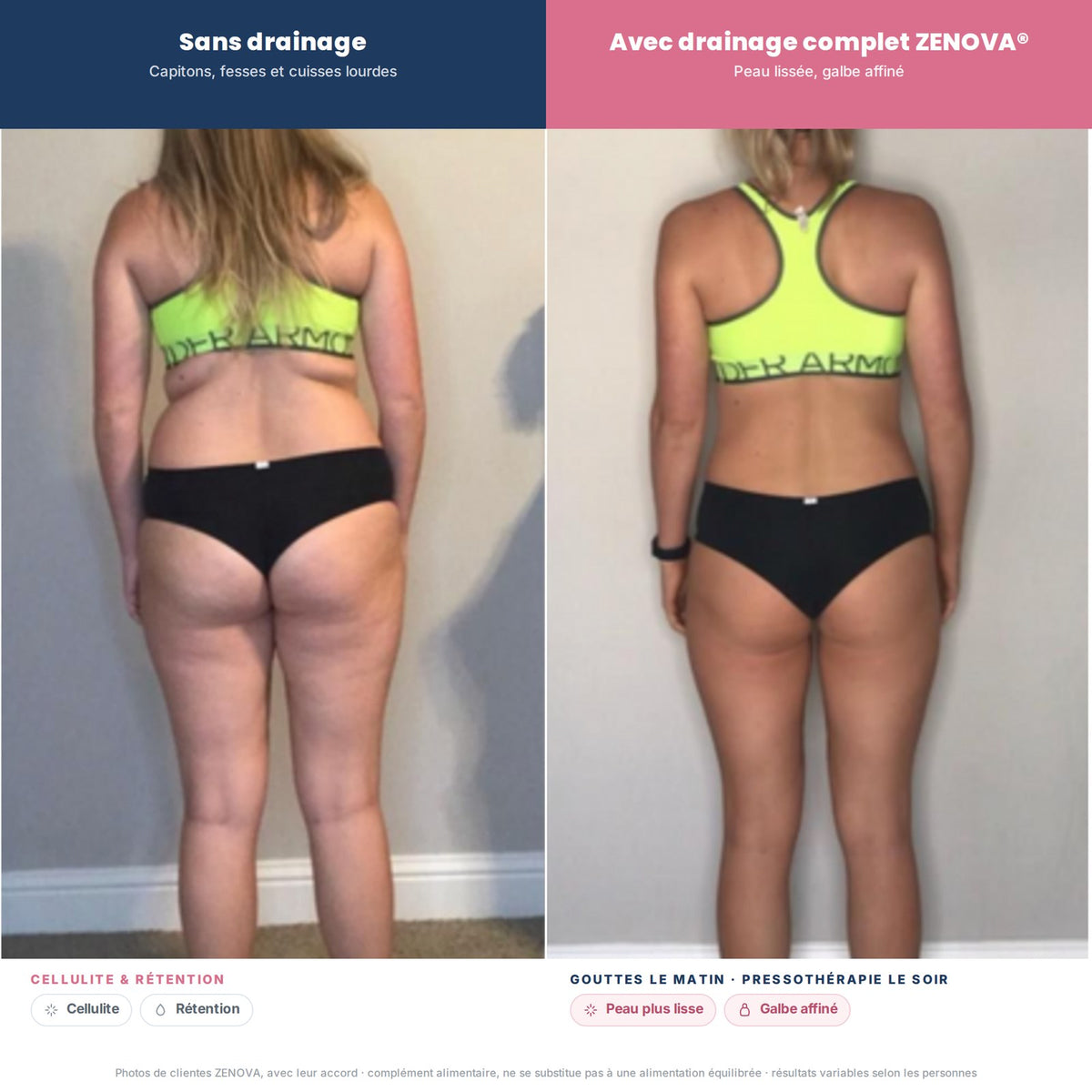 Avant / après drainage complet ZENOVA – cellulite et rétention